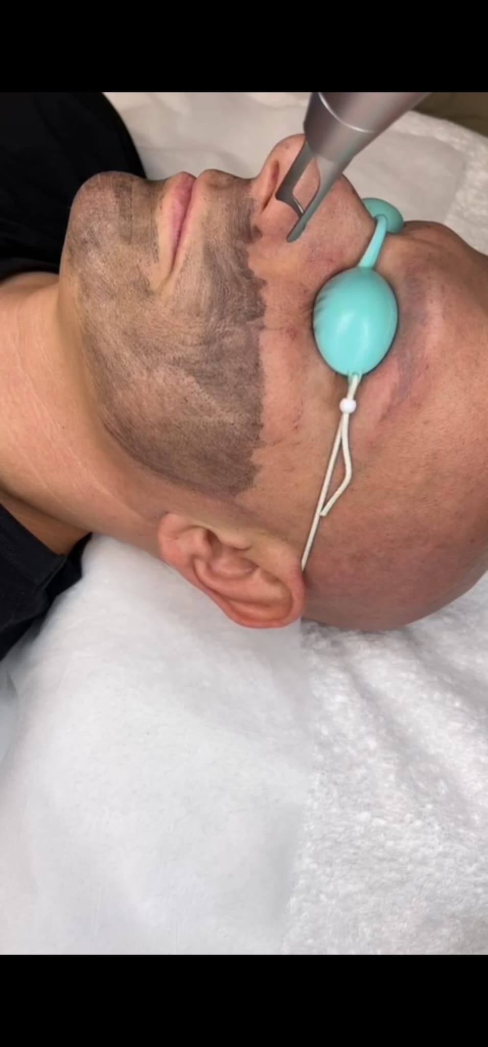 Traitement Carbon Peel