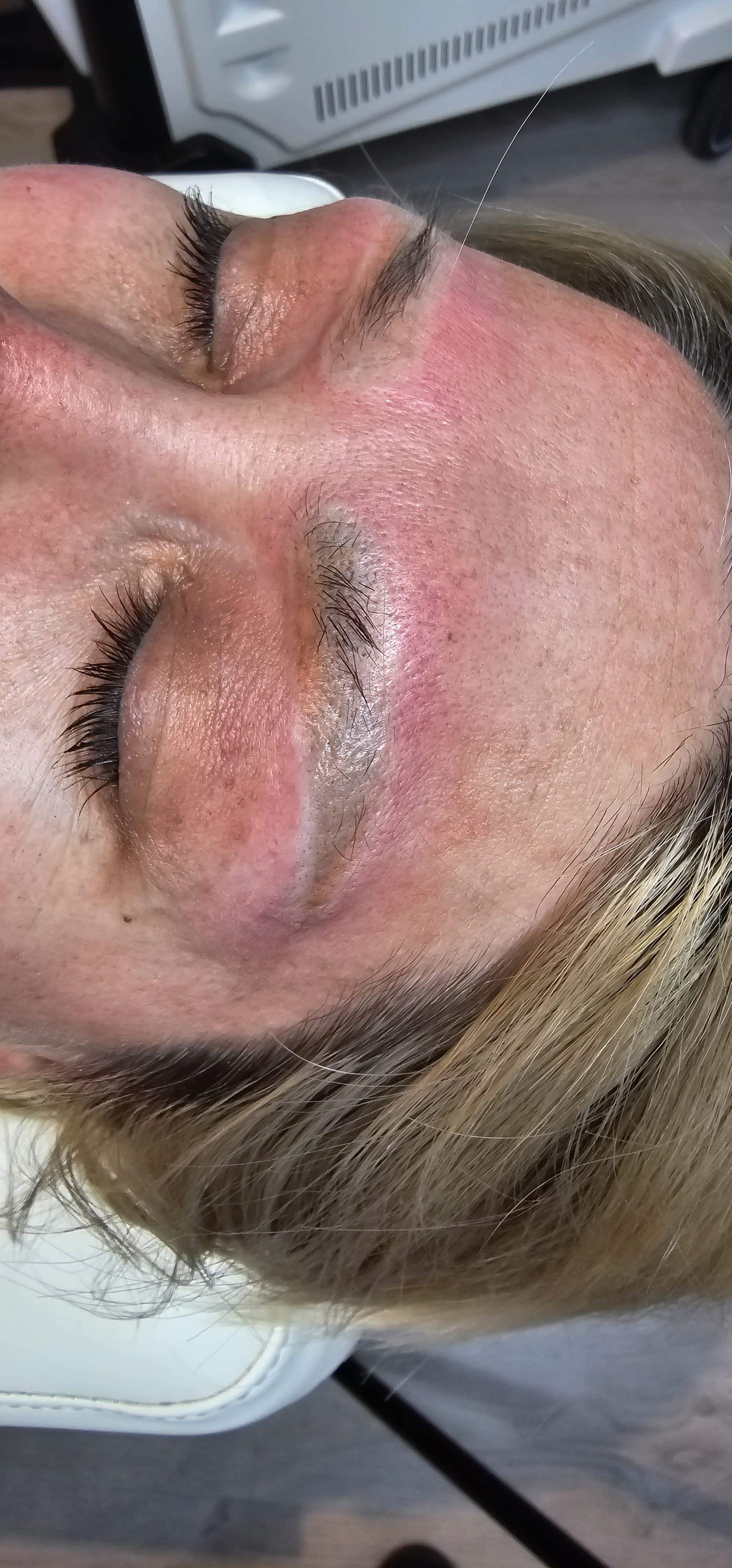 Après détatouage, Institut Skin-Line