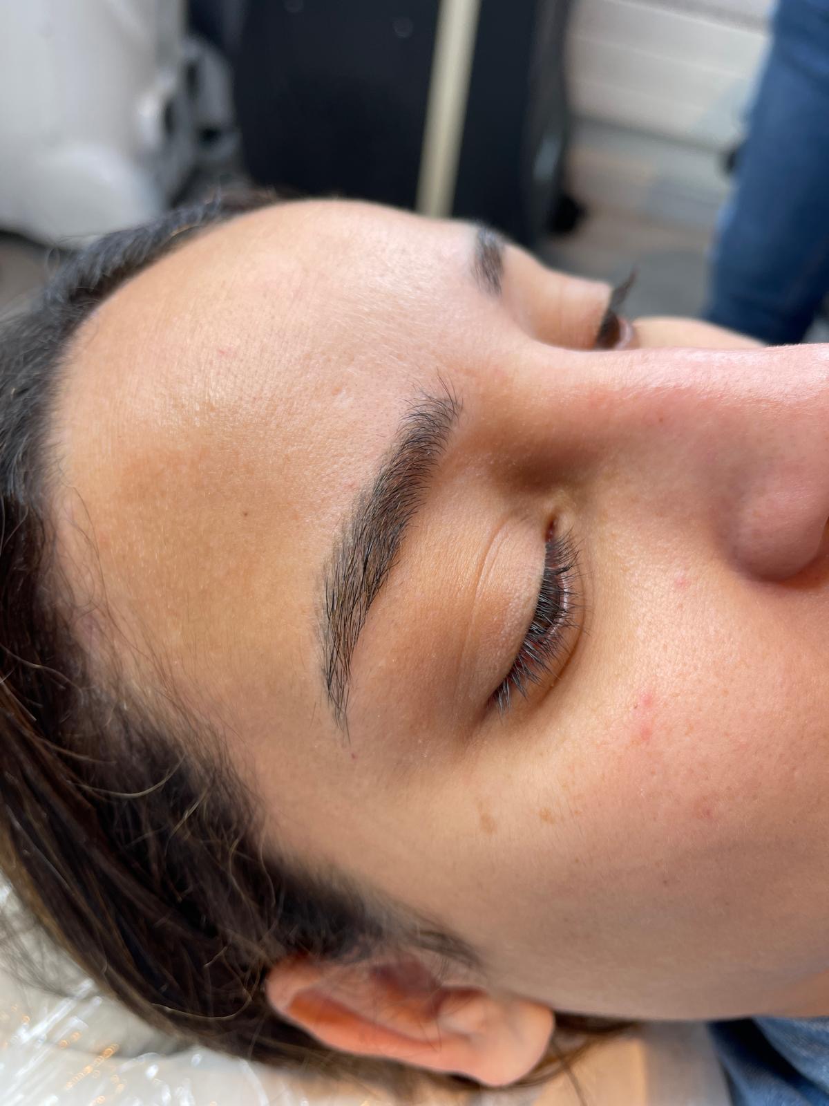 Après détatouage, Institut Skin-Line