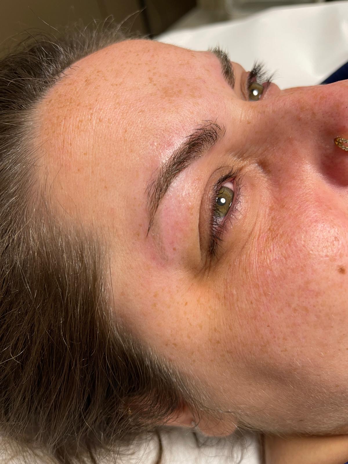 Après détatouage, Institut Skin-Line