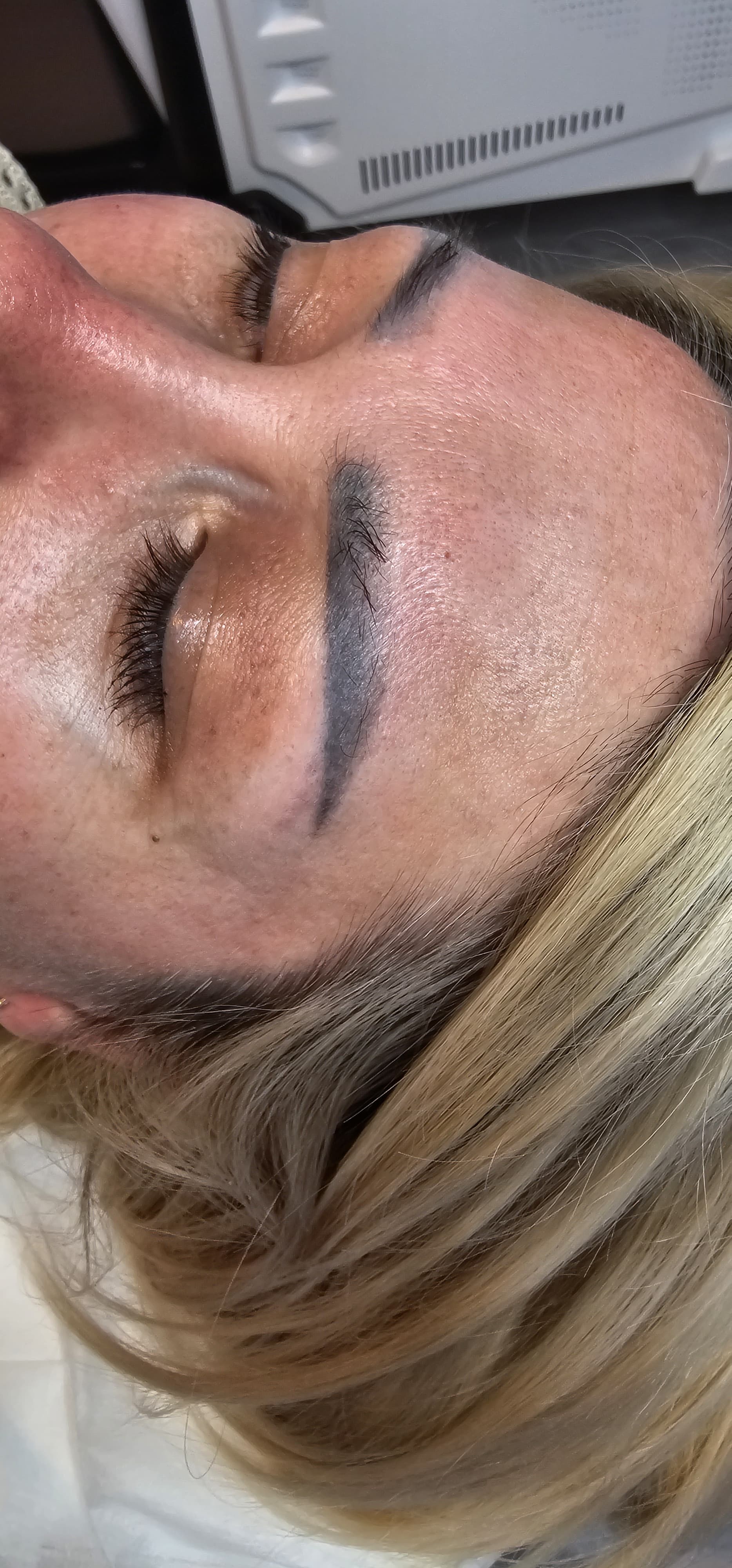 Avant détatouage, Institut Skin-Line