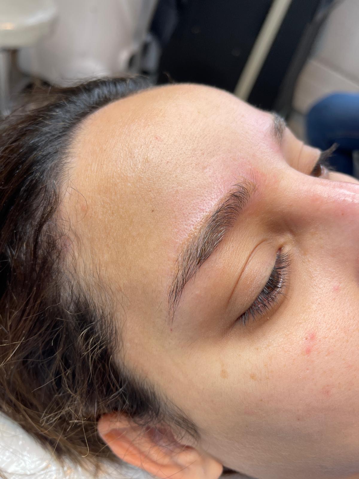 Avant détatouage, Institut Skin-Line