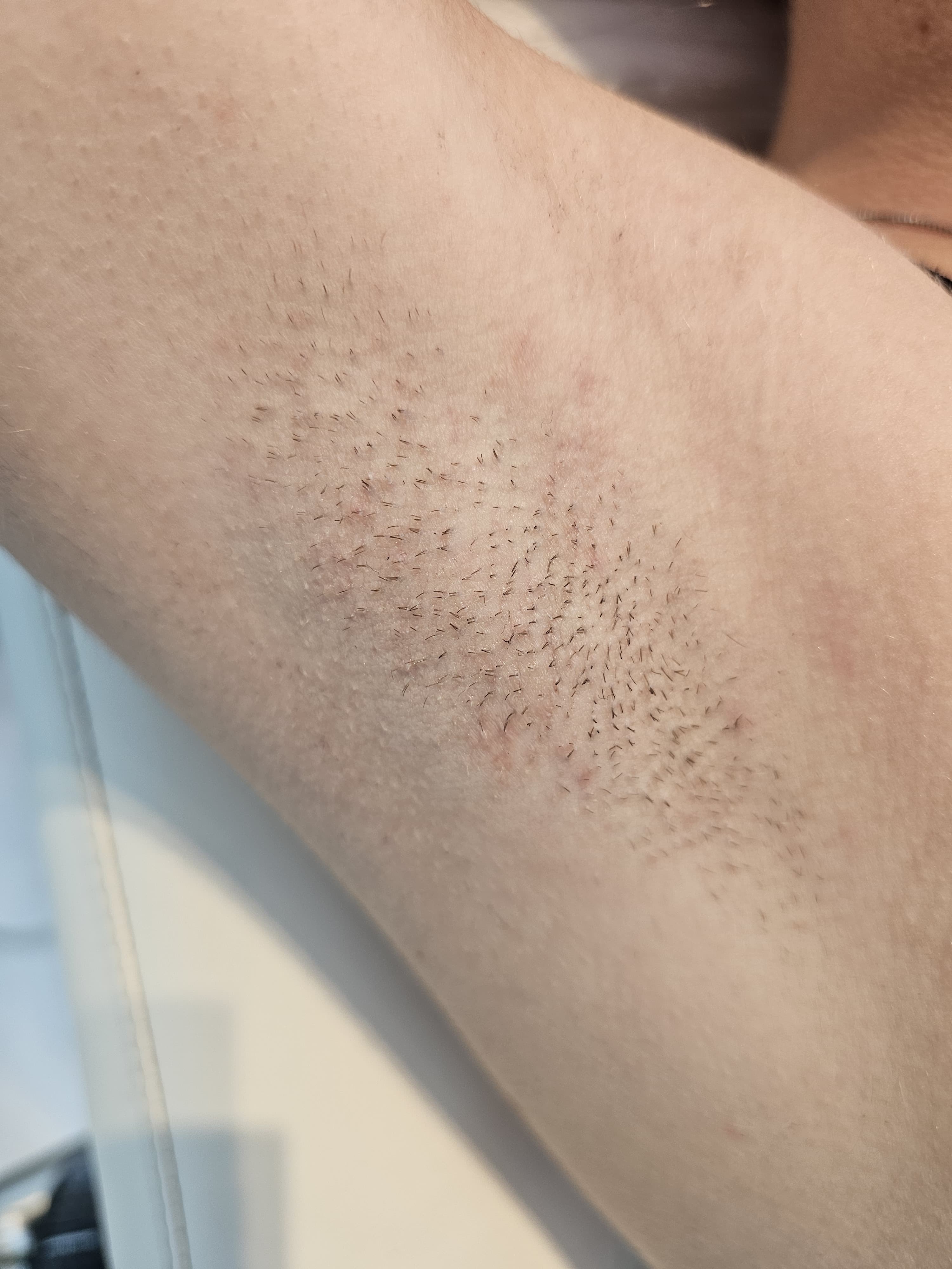 Avant épilation définitive, Institut Skin-Line